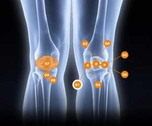 Douleurs au genou - Rive Sud - OrthoAction