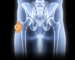 Douleurs à la hanche - Rive Sud - OrthoAction