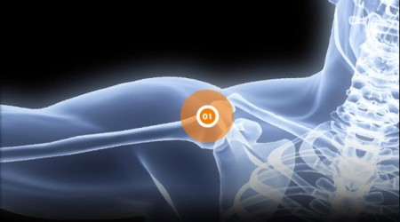 Luxation | Douleur à l'épaule | OrthoAction